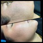 Dermaplaning