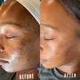 Chemical Peel