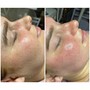 Chemical Peel Facial