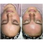 LED Light Therapy Facial