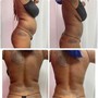 3 session Body Sculpting