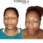 Acne Facial w/enzyme peel