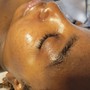 Microdermabrasion