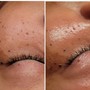 Microdermabrasion