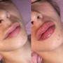 Lips- 1 ML Lip Infusion