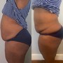 Back leg reduction with cellulite reduction