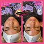 Microdermabrasion Facial