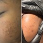 Microdermabrasion