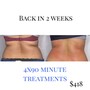 30 min Fat Cavitation on one area