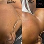 Back Treatment