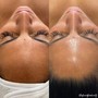 Hydro Facial