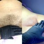 Underarms with Steam extractions