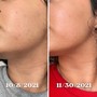 Micro-Channeling/Needling Facial