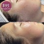 Dermaplaning Facial