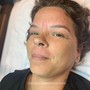 Micro-Channeling/Needling Facial