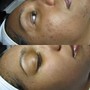 Pomegranate Enzyme Acne Facial