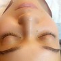 Microdermabrasion