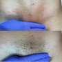 Microdermabrasion