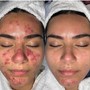 Pomegranate Enzyme Acne Facial