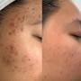 Microdermabrasion