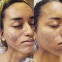 Chemical peel