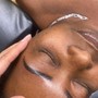 Acne Facial