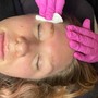 Anti-aging Chemical peel