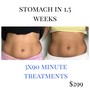 30 min Fat Cavitation on one area