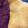 Tweezing ingrown hair's (beard)