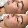 Hand Treatment- HydraFacial