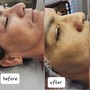 Acne Facial