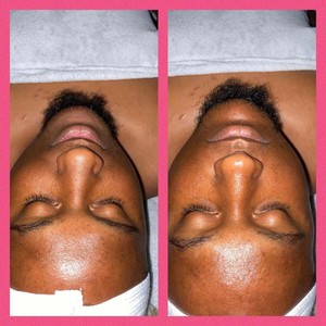 Chemical Peel Near Me Downey CA Appointments StyleSeat