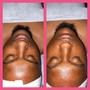 Dermaplaning Facial