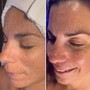 60 Minute Acne Facial And High Frequency treatment