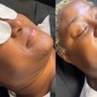 Oxygen Facial