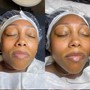 Acne Facial