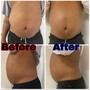 2 Area Laser Lipo