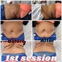 2 Area Laser Lipo