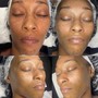 Acne Facial