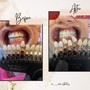 60 min Teeth Whitening - 24K gold