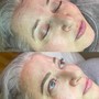 Cheek/Jowl Lift and Tightening