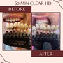 60 min Teeth Whitening - 24K gold