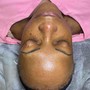 Acne Facial