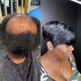 Hair Restoration Treatment