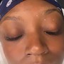 Hyperpigmentation/Dark Marks Chemical peel