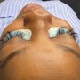 Microdermabrasion