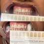 Teeth Whitening (60min)