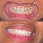 Teeth Whitening 30min Treatment