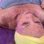 Microdermabrasion