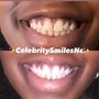 Teeth Whitening (Standard)